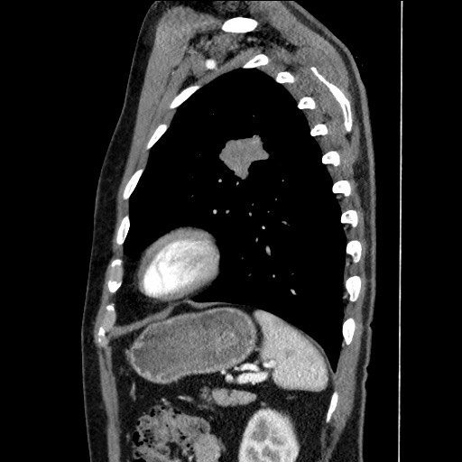 File:Adenocarcinoma of the lung (Radiopaedia 59871-67325 Sagittal C+ arterial phase 80).jpg