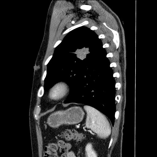 File:Adenocarcinoma of the lung (Radiopaedia 59871-67325 Sagittal C+ arterial phase 83).jpg