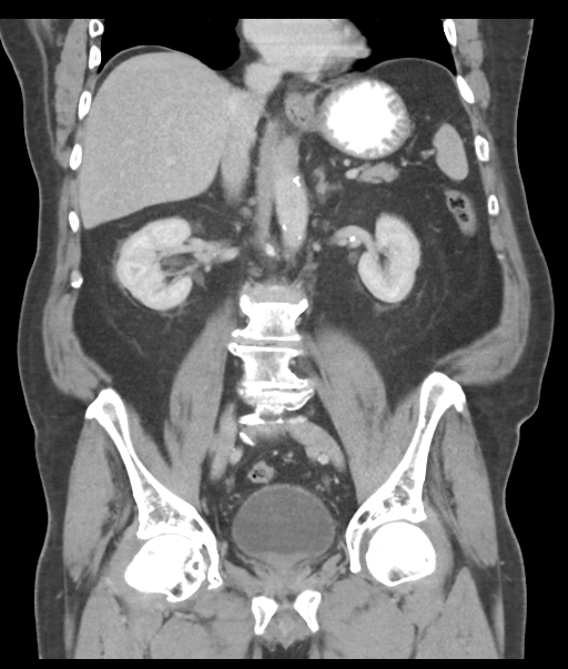 Adenocarcioma of rectum- T1 lesion (Radiopaedia 36921-38547 Coronal C+ portal venous phase 36).png