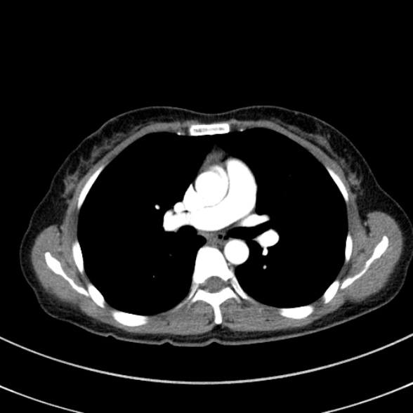 Adenocystic carcinoma of the trachea (Radiopaedia 47677-52525 Axial C+ arterial phase 50).jpg