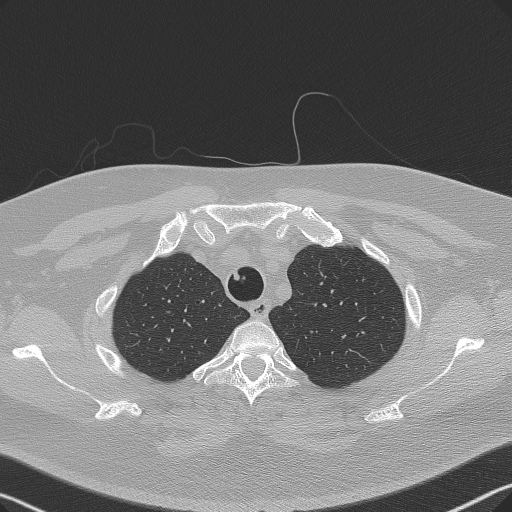 Adenoid cystic carcinoma of the trachea (Radiopaedia 49042-54137 Axial lung window 60).jpg