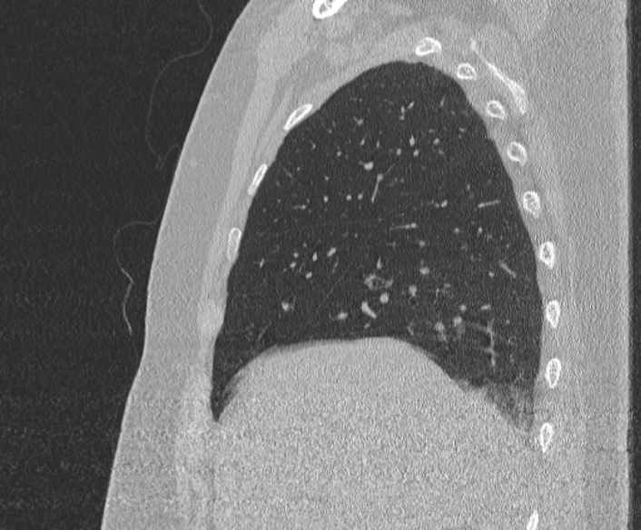 Adenoid cystic carcinoma of the trachea (Radiopaedia 49042-54137 Sagittal lung window 120).jpg