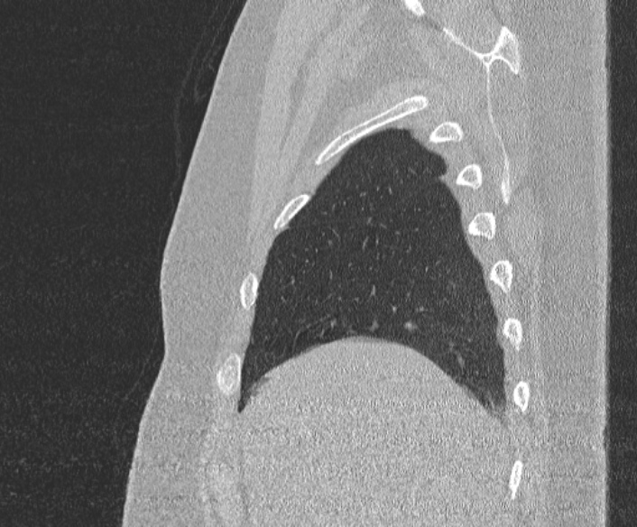 Adenoid cystic carcinoma of the trachea (Radiopaedia 49042-54137 Sagittal lung window 74).jpg