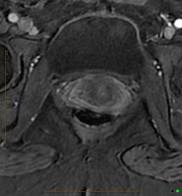 Adenomyosis uterus with hematometra (Radiopaedia 45779-50011 Axial T1 C+ fat sat 59).jpg