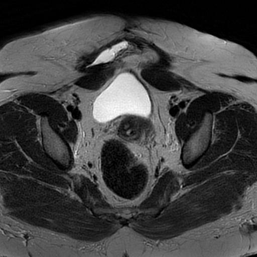 File:Adenomyosis within a didelphys uterus (Radiopaedia 70175-80215 Axial T2 20).jpg