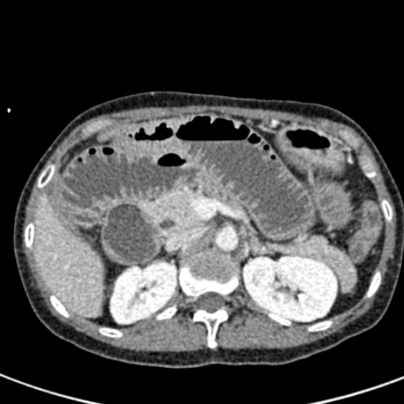 Adhesional small bowel obstruction (Radiopaedia 48397-53305 Axial C+ portal venous phase 22).jpg