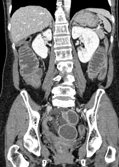 Adhesional small bowel obstruction (Radiopaedia 48397-53305 Coronal C+ portal venous phase 225).jpg