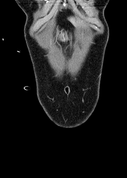 Adhesional small bowel obstruction (Radiopaedia 48397-53305 Coronal C+ portal venous phase 32).jpg