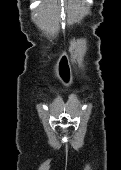 Adhesional small bowel obstruction (Radiopaedia 48397-53305 Coronal C+ portal venous phase 330).jpg