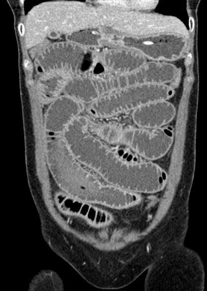 Adhesional small bowel obstruction (Radiopaedia 48397-53305 Coronal C+ portal venous phase 96).jpg