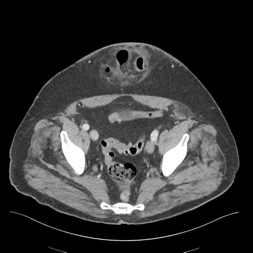 File:Adhesions within abdominal wall hernia (Radiopaedia 58283-65394 Axial C+ portal venous phase 71).png