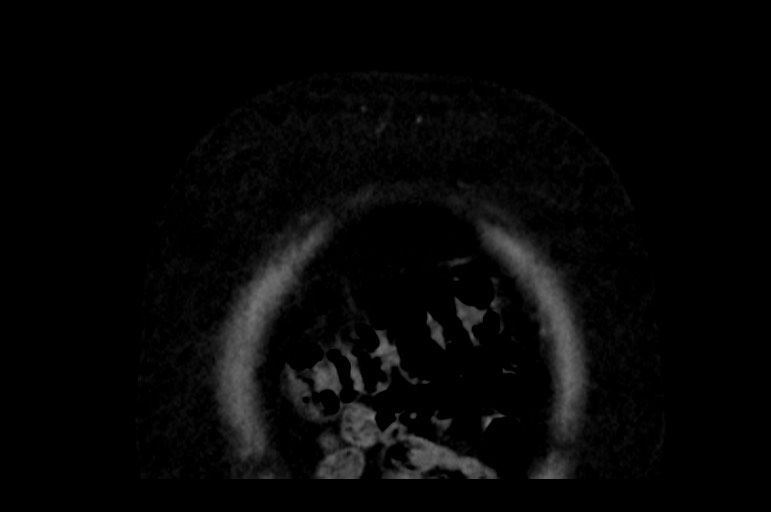 Adrenal cortical carcinoma (Radiopaedia 64017-72769 Coronal non-contrast 5).jpg