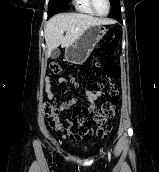 Adrenal cortical carcinoma (Radiopaedia 84882-100379 Coronal C+ portal venous phase 15).jpg