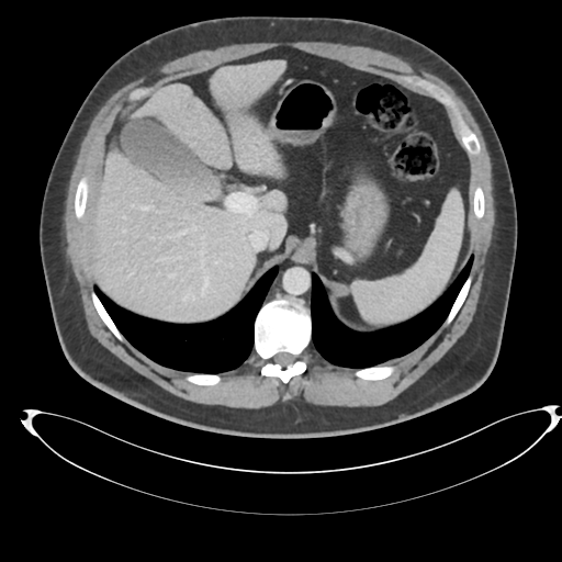 File:Adrenal cyst (Radiopaedia 45625-49778 AXIAL THICK 60 sec 10).png