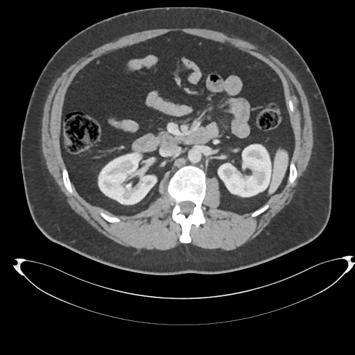 File:Adrenal cyst (Radiopaedia 45625-49778 AXIAL THICK 60 sec 35).png