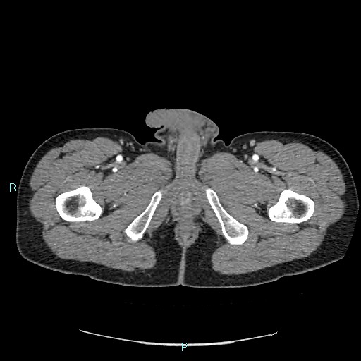 Adrenal cystic lymphangioma (Radiopaedia 83161-97534 Axial C+ arterial phase 110).jpg
