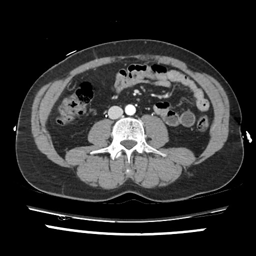 Adrenal gland trauma (Radiopaedia 81351-95078 Axial Dual bolus trauma C+ 83).jpg