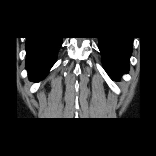 Adrenal gland trauma (Radiopaedia 81351-95079 Coronal non-contrast 77).jpg