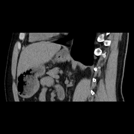 Adrenal gland trauma (Radiopaedia 81351-95079 Sagittal non-contrast 60).jpg
