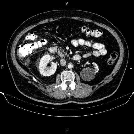 Adrenal hemorrhage (Radiopaedia 62622-70916 Axial C+ portal venous phase 82).jpg