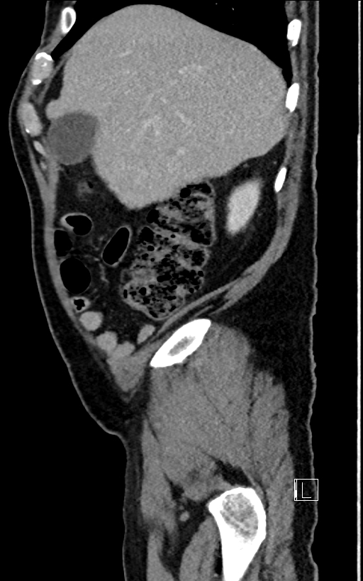 Adrenal lymphoma (Radiopaedia 73730-84529 Sagittal C+ portal venous phase 18).jpg