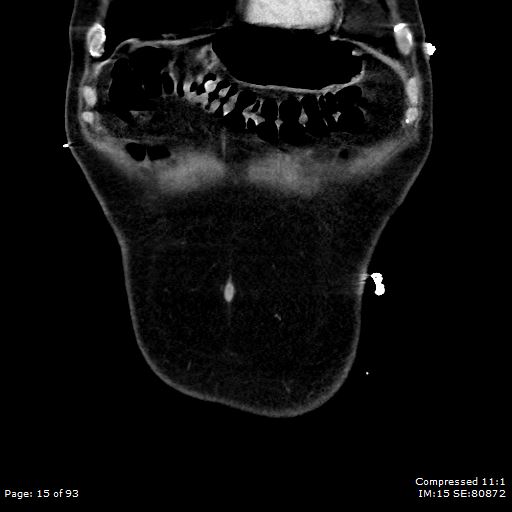 Adrenal metastasis (Radiopaedia 78425-91079 Sagittal C+ portal venous phase 2).jpg