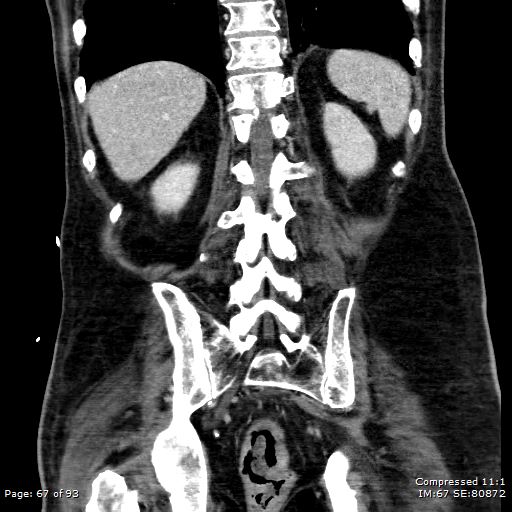 File:Adrenal metastasis (Radiopaedia 78425-91079 Sagittal C+ portal venous phase 54).jpg