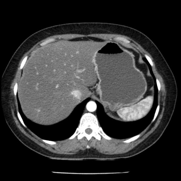 Adrenal myelolipoma (Radiopaedia 43401-46759 Axial C+ arterial phase 16).jpg