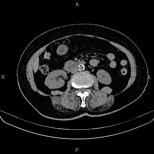 Adrenal myelolipoma (Radiopaedia 82742-96986 Axial non-contrast 79).jpg