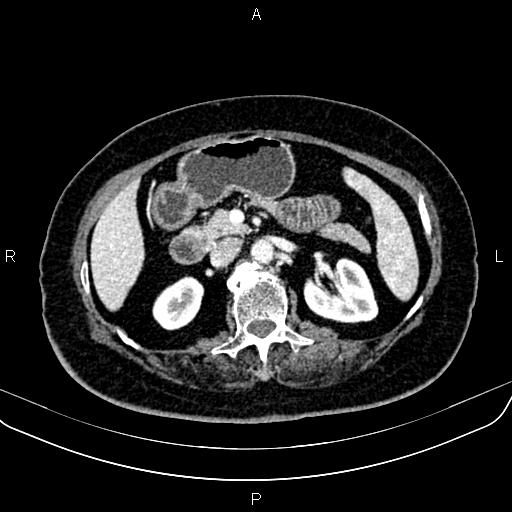 Adrenal myelolipoma (Radiopaedia 82742-96986 Axial renal cortical phase 67).jpg