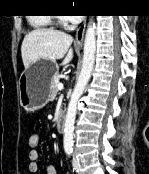 Adrenal myelolipoma (Radiopaedia 82742-96986 Sagittal renal cortical phase 57).jpg