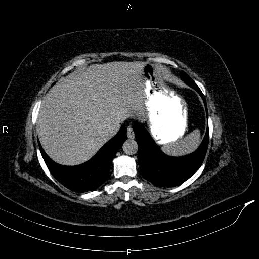 Adrenal myelolipoma (Radiopaedia 84319-99617 Axial With oral contrast 32).jpg