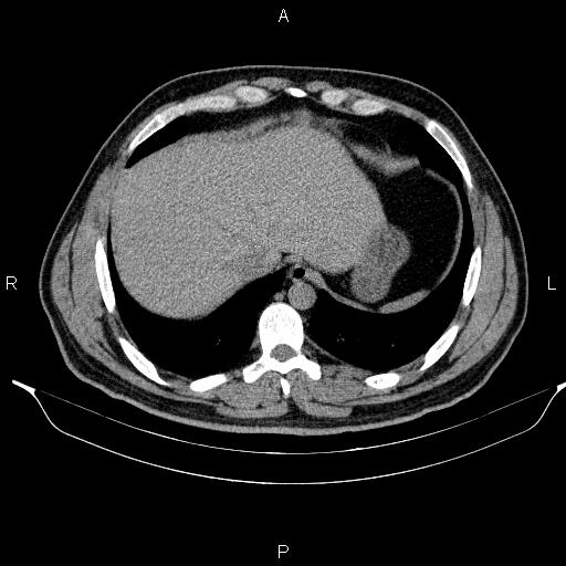Adrenal myelolipoma (Radiopaedia 84321-99619 Axial non-contrast 16).jpg