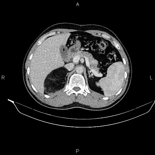 Adrenal myelolipoma (Radiopaedia 87794-104246 Axial renal cortical phase 31).jpg