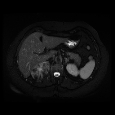 File:Adrenal myelolipoma - MRI (Radiopaedia 83249-97646 Axial STIR 14).jpg