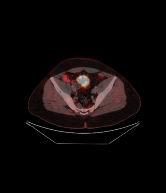Adrenocortical carcinoma (Radiopaedia 80134-93440 ِAxial 230).jpg