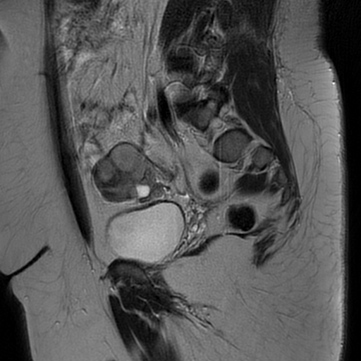 File:Adult granulosa cell tumor of the ovary (Radiopaedia 64991-73953 Sagittal T2 11).jpg