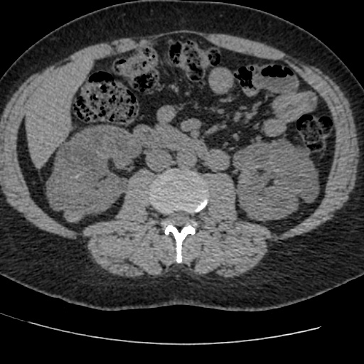 Adult polycystic kidney disease (Radiopaedia 59075-66368 Axial non-contrast 40).jpg