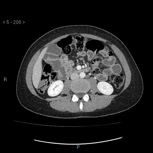 Adult transient intestinal intussusception (Radiopaedia 34853-36310 Axial C+ portal venous phase 38).jpg