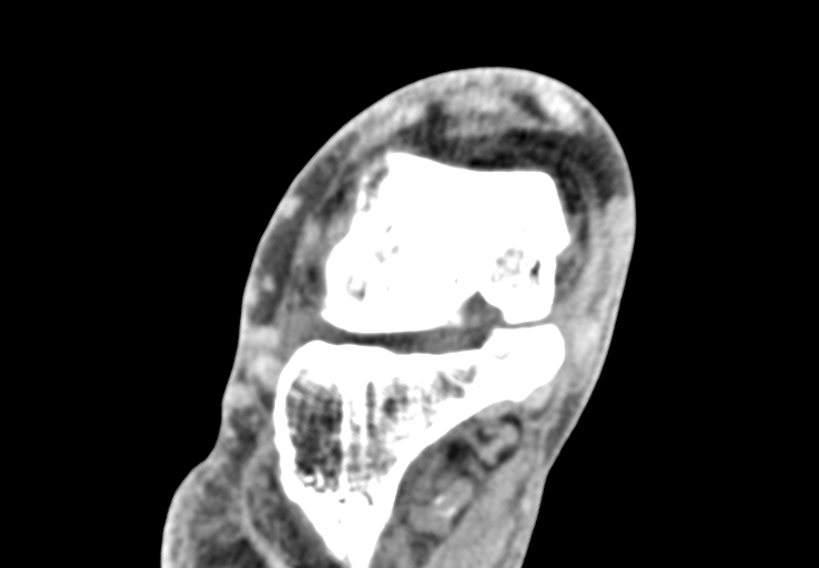 Advanced osteomyelitis due to open metatarsal fracture (Radiopaedia 83891-99095 Axial non-contrast 9).jpg
