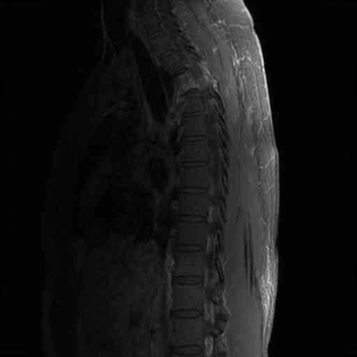 File:Aggressive vertebral hemangioma (Radiopaedia 39937-42404 B 14).png