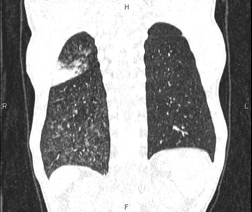 File:Air bronchogram in pneumonia (Radiopaedia 85719-101512 Coronal lung window 49).jpg