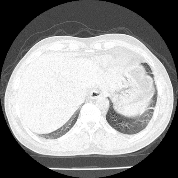 Airway foreign body in adult (Radiopaedia 85907-101779 Axial lung window 166).jpg