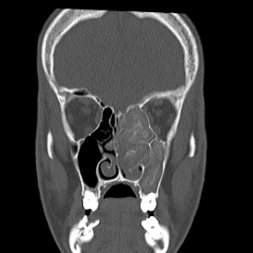 File:Allergic fungal sinusitis (Radiopaedia 29086-29455 Coronal bone window 12).jpg