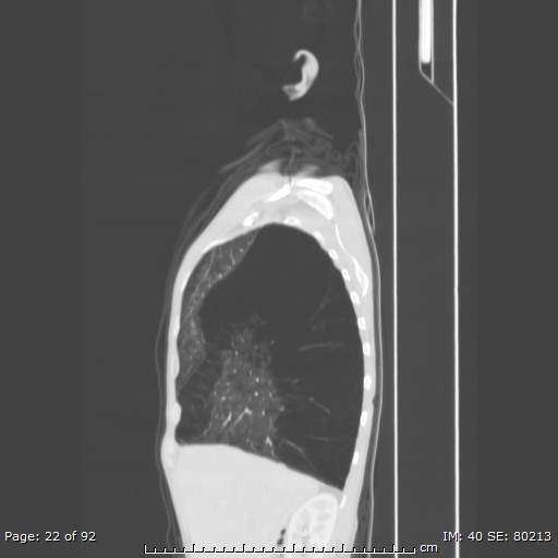 File:Alpha-1-antitrypsin deficiency (Radiopaedia 50561-55987 Sagittal lung window 11).jpg