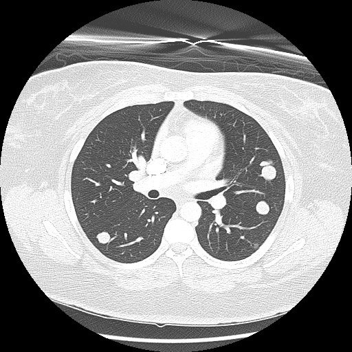 Alveolar soft part sarcoma - right leg (Radiopaedia 59432-67091 Axial lung window 50).jpg