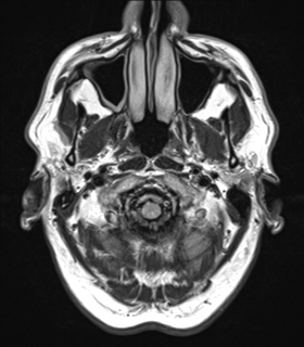 File:Alzheimer's disease- with Gerstmann syndrome and dressing apraxia (Radiopaedia 54882-61150 Axial FLAIR 1).png