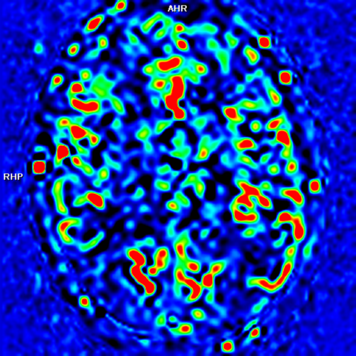 File:Alzheimer's disease- with apraxia (Radiopaedia 54763-61011 E 25).png