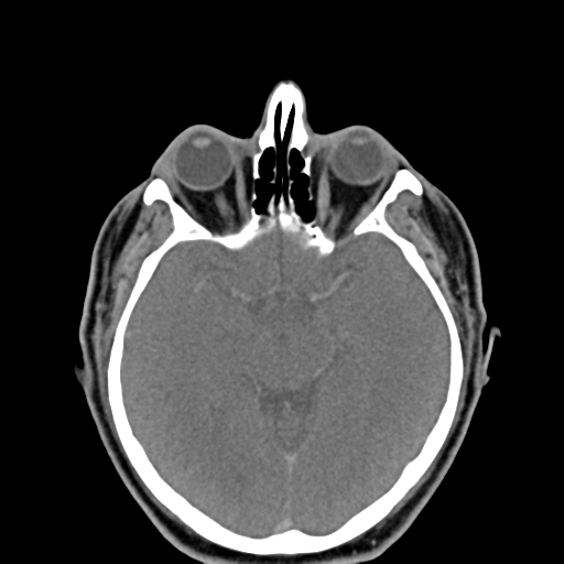 Ameloblastoma (Radiopaedia 38520-40623 Axial non-contrast 3).png