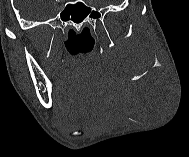 Ameloblastoma (Radiopaedia 51921-57766 Coronal bone window 134).jpg